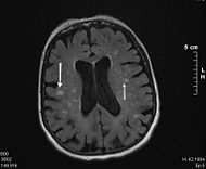 Leucoaraiose1.jpg