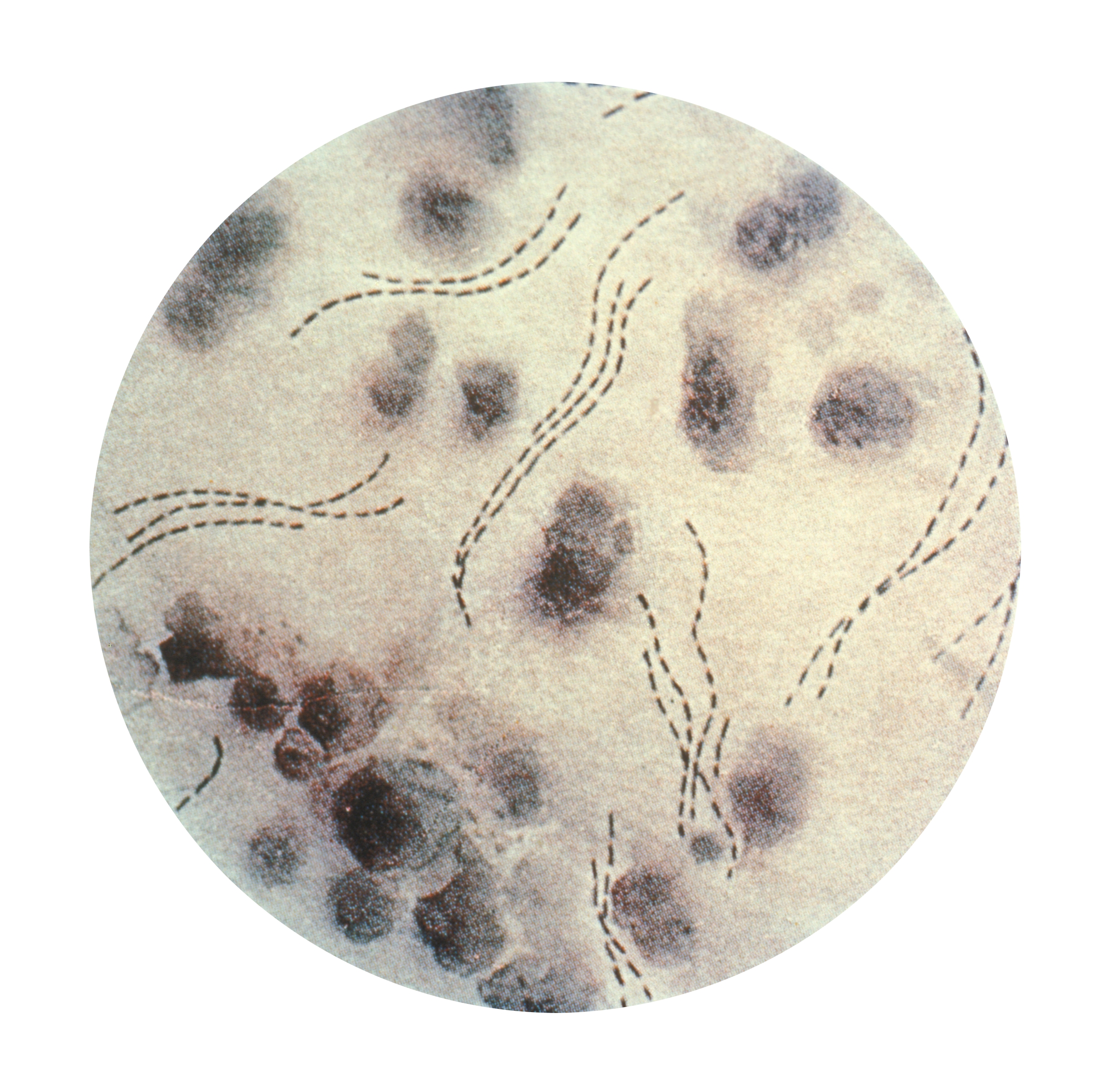 Фото шанкроида сифилиса на лобке 19 фотография
