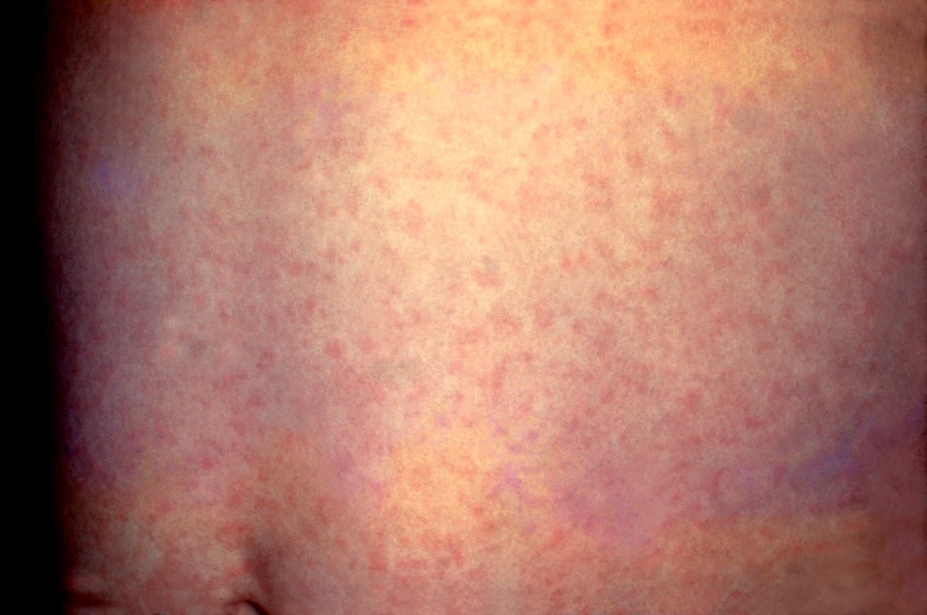 Fifth Disease Pictures | MedicalPictures.net